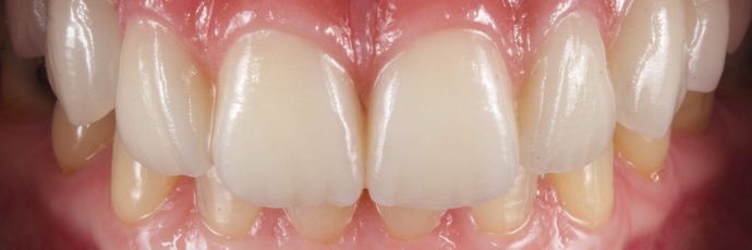 After dental bridge